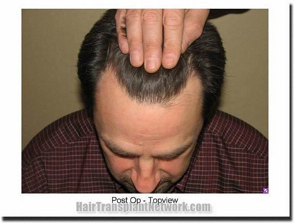 Hair restoration procedure results