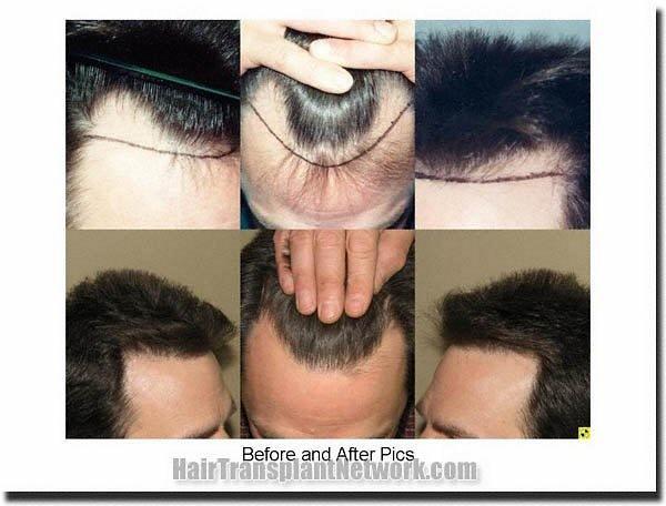 Hair restoration procedure results