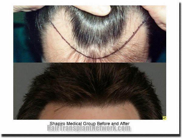 Hair restoration procedure results