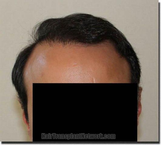 Hair restoration procedure results