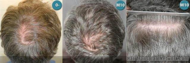 Crown / Back photos showing hair restoration results