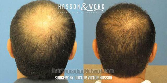 Hair transplantation surgery before and after photos
