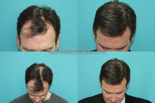 Top view - Before and after hair restoration procedure