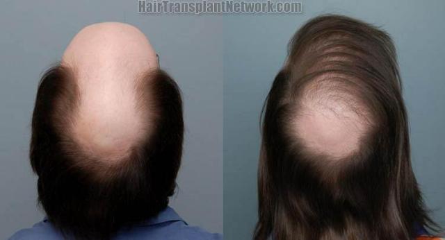 Back view before and after hair transplant