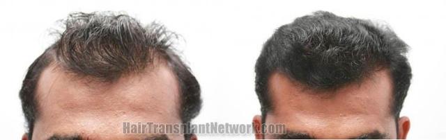 Before and after surgical hair replacement procedure