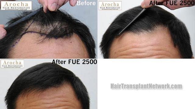 Hair restoration procedure before and after results