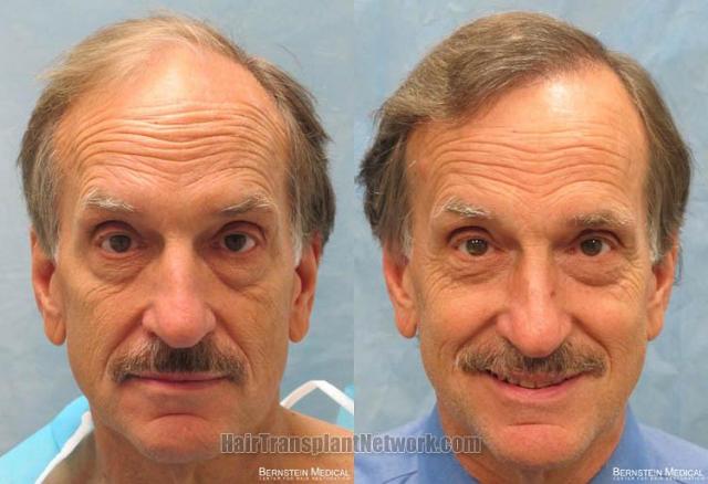 Front view - Before and after hair transplantation surgery