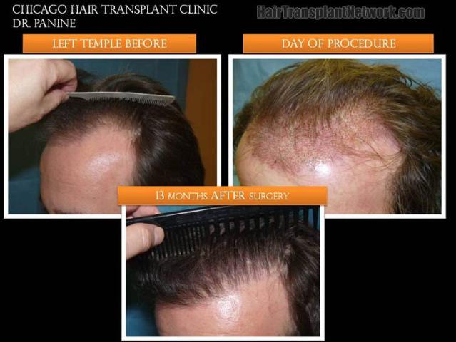 Hair transplantation surgery before and after photos