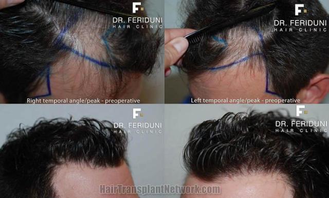 Hair restoration surgery before and after photos