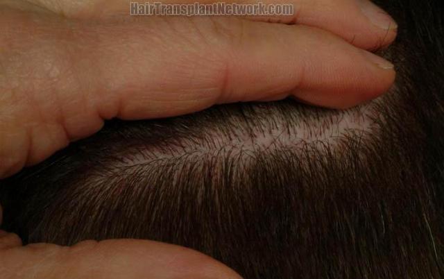 Residual hair transplant donor scar images