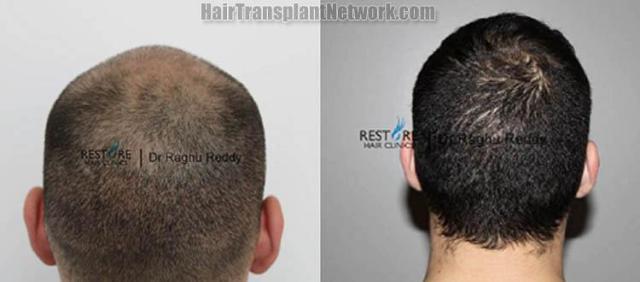 Hair transplantation surgery before and after pictures