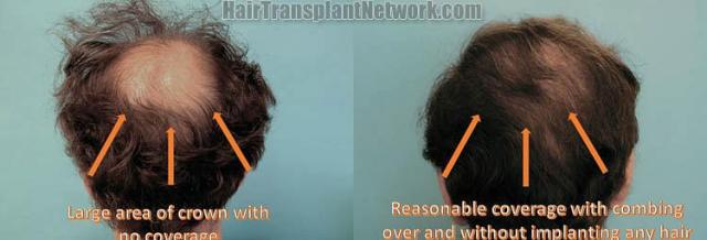 Hair restoration procedure before and after pictures