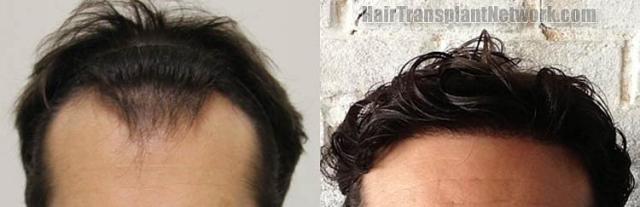 Hair transplantation surgery before and after pictures