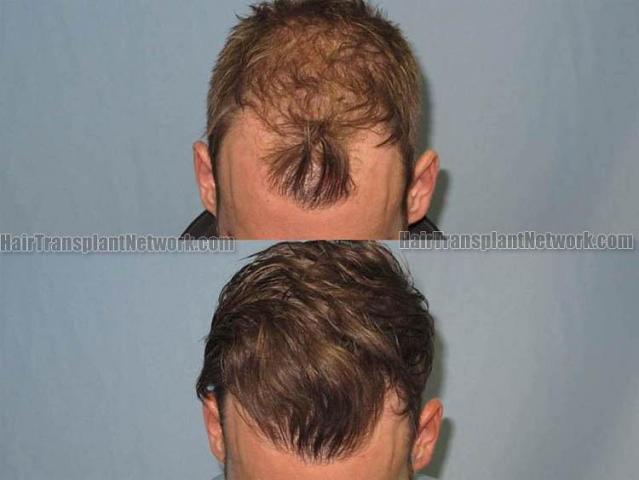 Hair restoration procedure before pictures