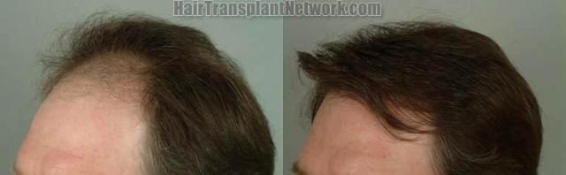 Hair transplantation surgery before and after photos