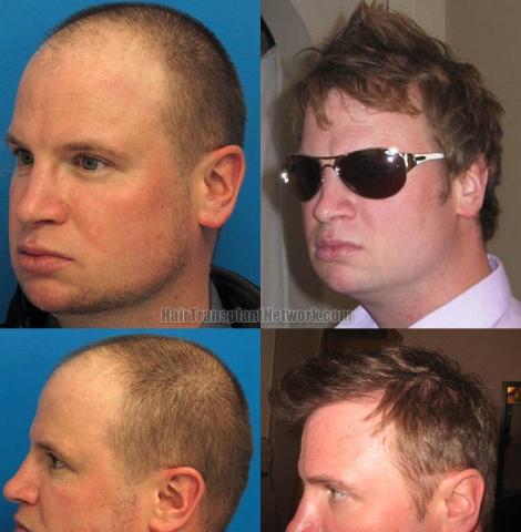 Hair transplantation surgery before and after pictures