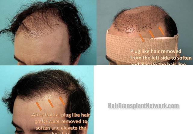 Hair transplantation surgery before and after pictures