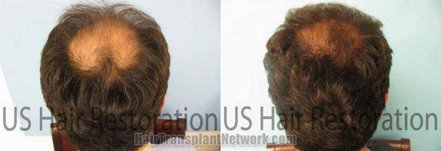 Back view of hair restoration procedure before and after 