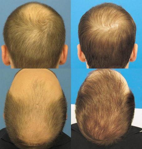 Back / Crown photos of hair transplant results