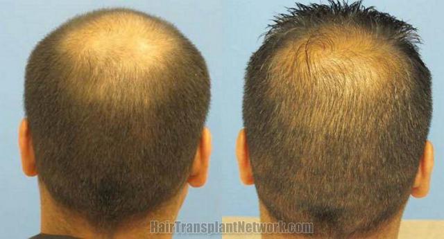 Back view pictures - Before and after hair transplant procedure