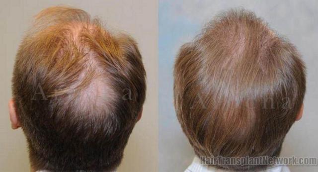 Back of head showing before and after hair replacement