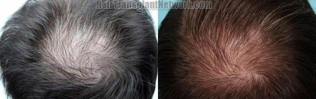 Before and after hair transplantation images