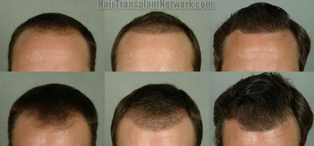 Hair restoration procedure results at six months- Front view