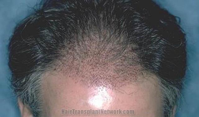 Hair restoration surgery immediate postoperative