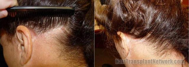 Hair restoration with 1302 grafts on a female patient