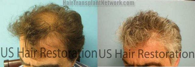 Left view - Hair replacement procedure photos