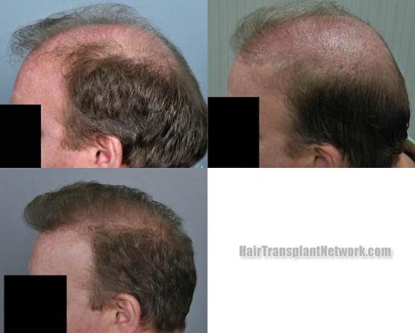 Hair transplantation surgery before and after pictures