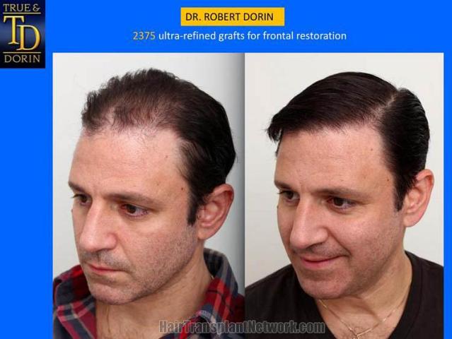 Hair transplantation surgery before and after images