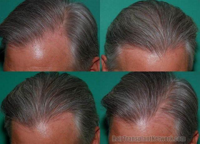 Right - Left side images of postoperative hair restoration procedure