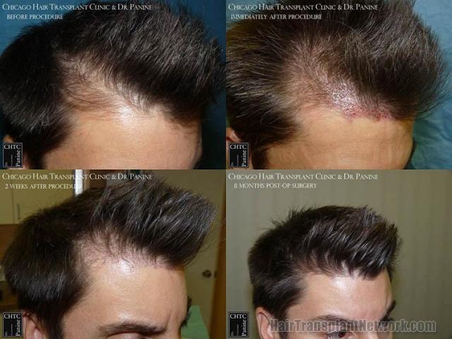 Hair restoration procedure before and after results