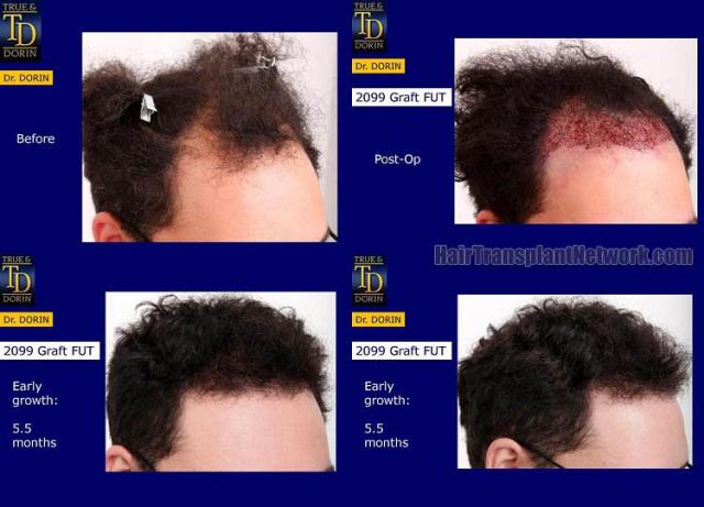 Hair transplantation surgery before and after photos