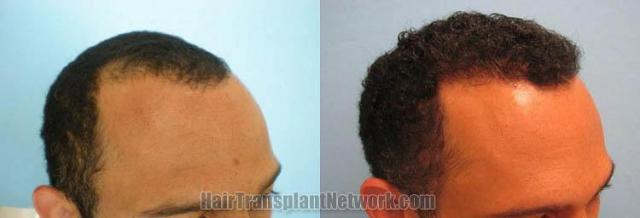 Hair restoration procedure before and after pictures