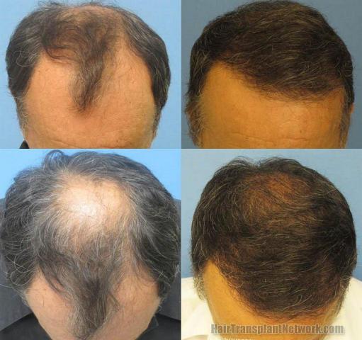 Hair restoration procedure with 4526 grafts before and after