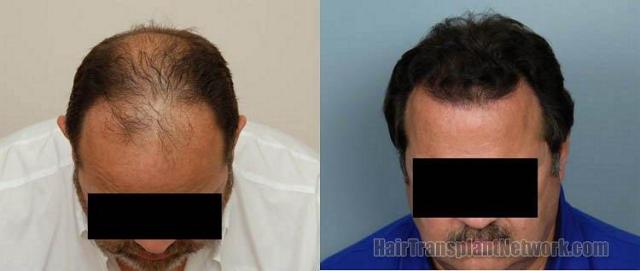 Top View - Hair restoration result photos