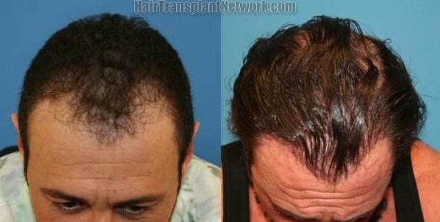 Top view - Before and after hair restoration photos