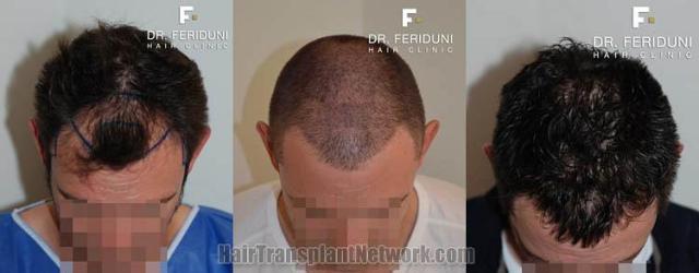 Top view before and after hair restoration results