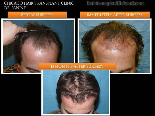 Top view before and after hair restoration results