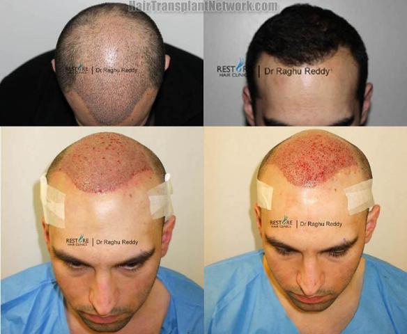 Hair restoration procedure before and after results