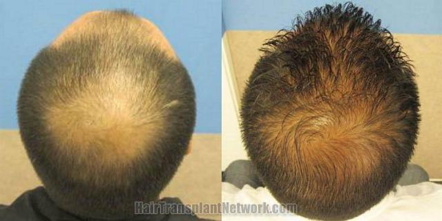 Photos of crown before and after hair transplant surgery