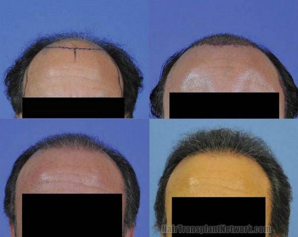 Hair transplant results front view