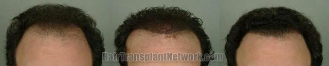 Front view before and after hair restoration procedure