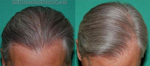 Front view photos showing postoperative hair transplant results