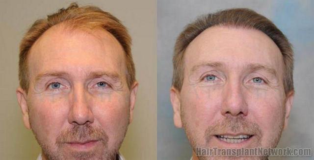 Front view - Before and after hair transplant photos