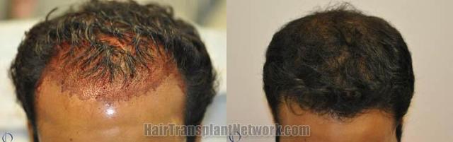 Hair restoration procedure before and after results