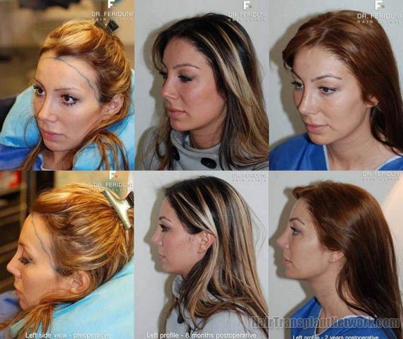 Left side photos of woman's hair restoration