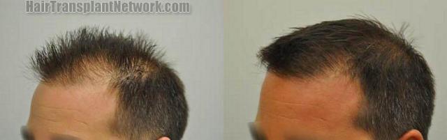 Left view before and after hair transplant procedure